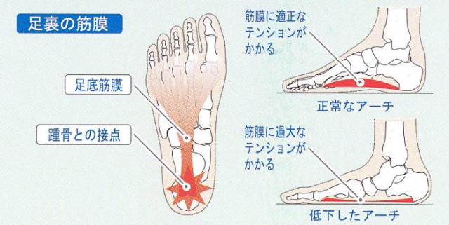 足のアーチと足底筋膜炎の関係