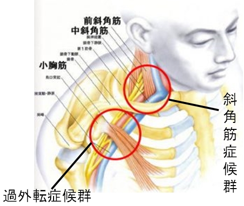 斜角筋症候群