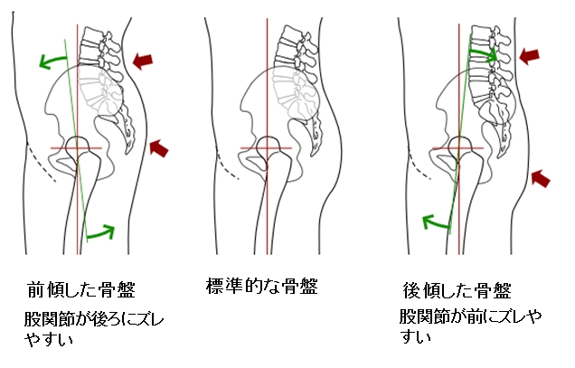 骨盤のゆがみと股関節の痛み