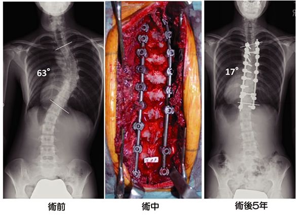 側弯症 下関の整体 菊川カイロプラクティック院 口コミno 1