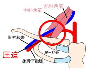 斜角筋による圧迫