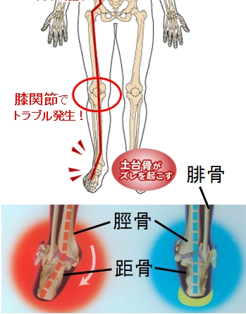 足、足首のゆがみから膝痛がおきる