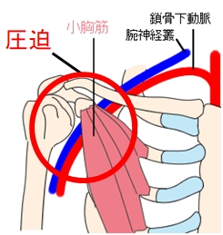 小胸筋による圧迫