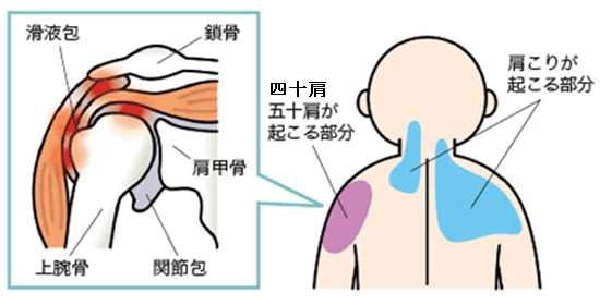 四十肩・五十肩がおきる原因