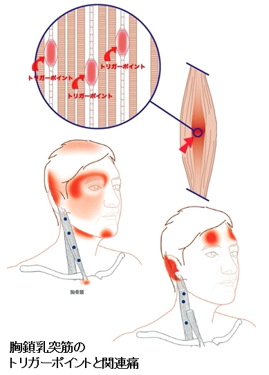 胸鎖乳突筋のトリガーポイントと関連痛